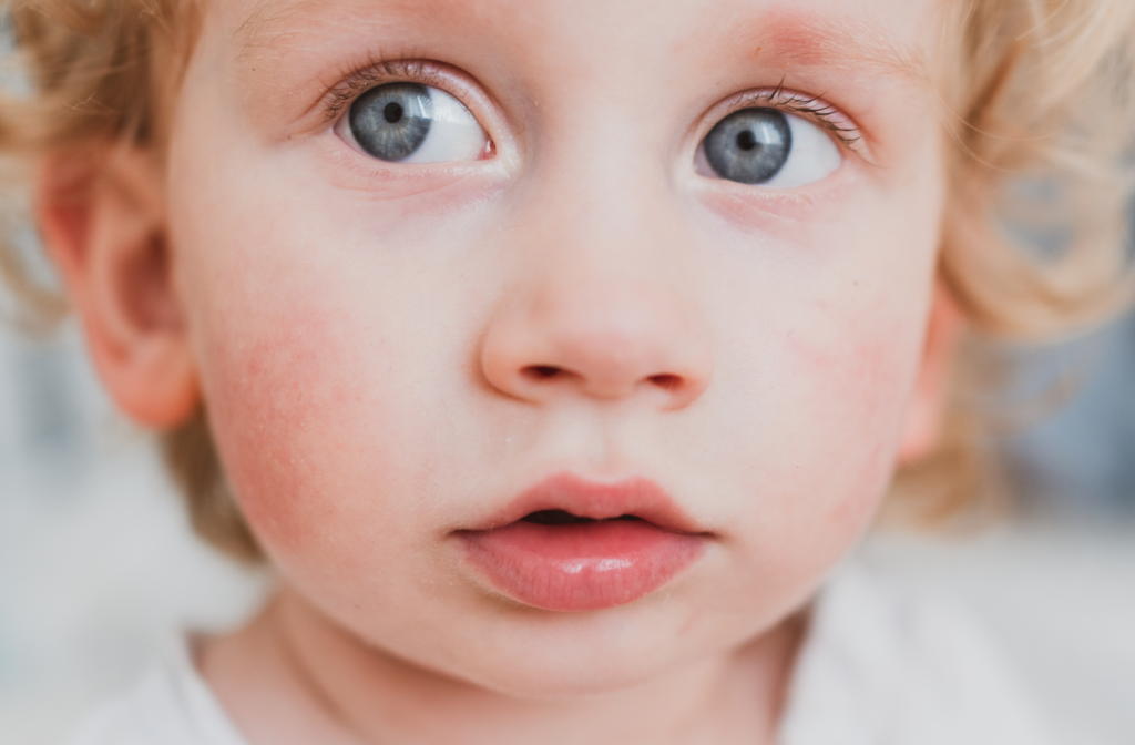 What Is Slapped Cheek Syndrome Parenting
